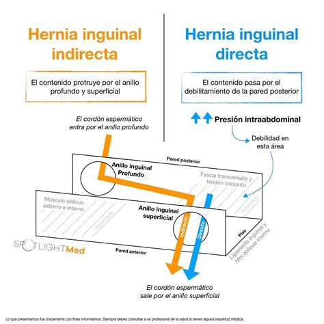 hernia inguinal directa e indirecta